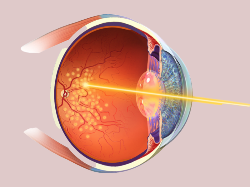 Retinopathy of Prematurity by Dr Sharon Enemuoh OD MBA