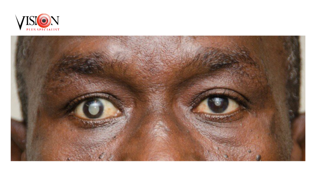 Eye specialist performing cataract surgery at Vision Plus Eye Clinic Victoria Island Lagos