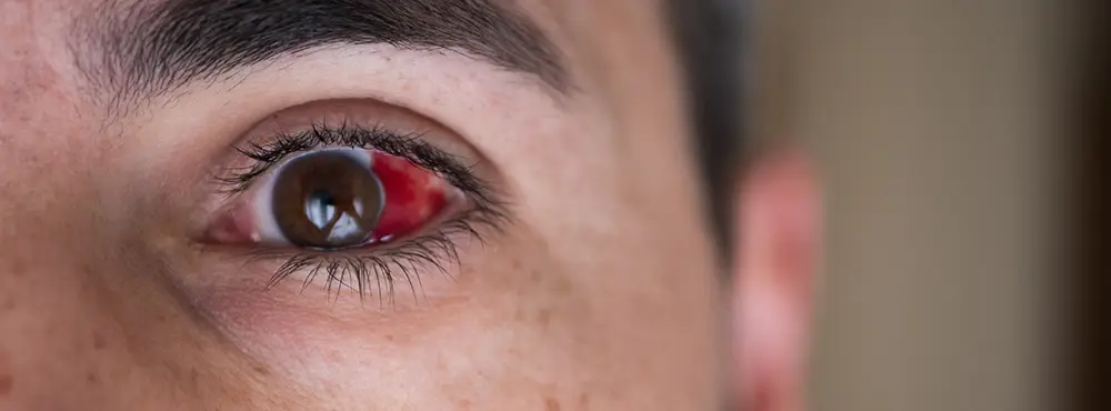 A close-up of an eye during an intraocular pressure test using a tonometer at Vision Plus Specialist Eye Clinic’s Victoria Island branch.
